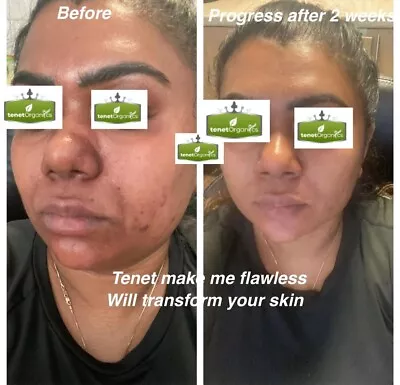 Skin Lightening Face Creams( Dark Mark Hyperpigmentation Acne Face Cream)  • £14