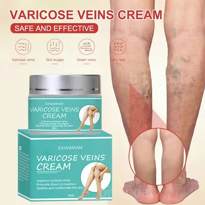 Varicose Vein Cream Herbal Reduce Swelling Relieve Pain Vasculitis Varicose Vein • £9.95